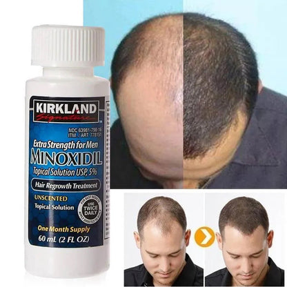 Minoxidil 5% Traitement Extra Fort Pour La Repousse Des Cheveux